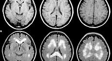 Acid folic în prevenirea primului accident vascular cerebral - medicină bazată pe dovezi pentru toți