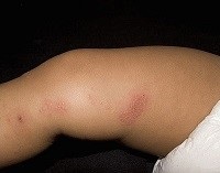 Herpesul pe simptomele piciorului și tratamentul - vii sănătoși