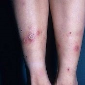 Herpesul pe simptomele piciorului și tratamentul - vii sănătoși
