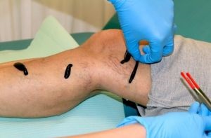 Hirudoterapie cu tratament varicos pentru picioare, contraindicații, puncte de instalare, fotografie