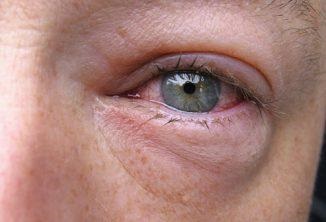 Picături oculare cauzate de leșiere și tratament, care, ieftin, au crescut, durere în ochi