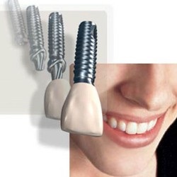 Implantarea dinților la un preț avantajos în Ekaterinburg