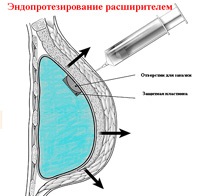 Implanturile mamare, tipurile, umplutura, alegerea formei implantului