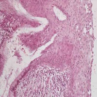 Leziunile celulare scuamoase intraepiteliale ale colului uterin