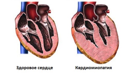 Cardiomiopatia ischemică atunci când viața este amenințată