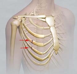 Izolate fracturi ale coastelor, traumatologie pentru toți