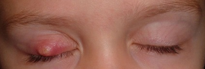 Cât de repede și eficient pentru a vindeca orzul pe ochi (4 fotografii), frumusețea și sănătatea