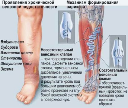 Cum să tratăm vene varicoase la bărbați la remediile populare acasă și la medicamente