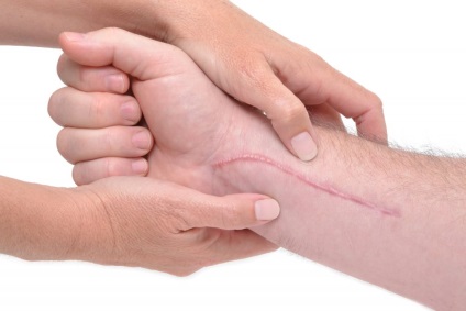 Cum să eliminați cicatricile din tăieturile de pe braț la fotografia de acasă