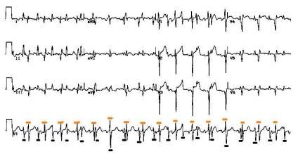 Cardiomiopatia ischemică