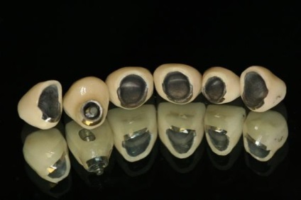 Kombinált koronák a fogak előnyei és hátrányai