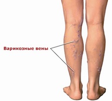 Összetevők, kenőcsök, tinktúrák és egyéb népi gyógymódok a dilatációjú vénák kezelésére a lábakon
