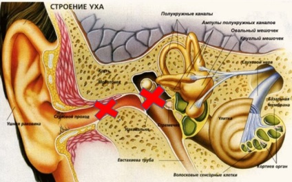 Conductiva surzenie a tratamentului de gradul 1, 2, 3 grad de formare bilaterală la copii