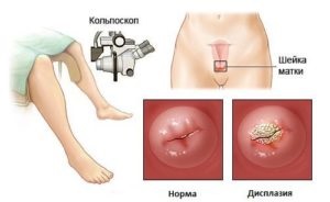 Cryodestrucția displaziei cervicale, indicații, beneficii, prețuri