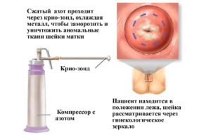 Cryodestrucția displaziei cervicale, indicații, beneficii, prețuri