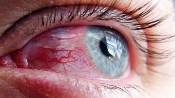Hemoragia în ochi ce să faceți, dacă este în vitreous, sclera - cauze și tratamentul cu picături