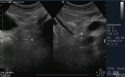 Cine a spus că ureterele nu sunt vizibile pe continuarea Uzi