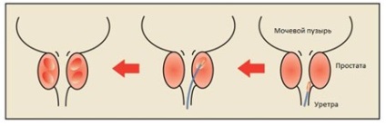 Tratamentul adenomului prostatic cu laser