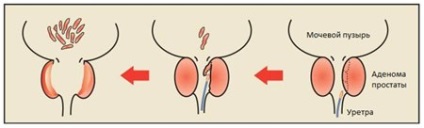 Tratamentul adenomului prostatic cu laser