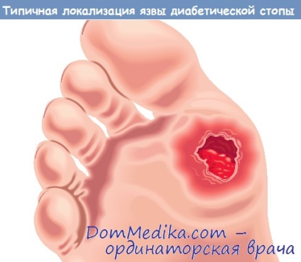 Лікування діабетичної стопи без операції