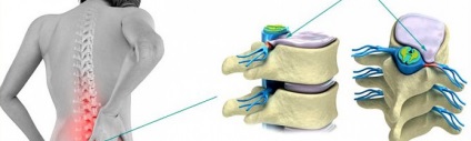 Tratamentul unei hernie a coloanei vertebrale