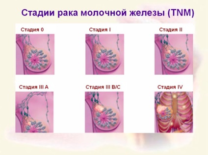 Tratamentul cancerului mamar - clinica 