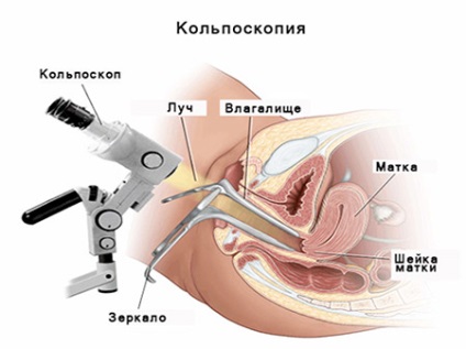 Leucoplazia cervicală