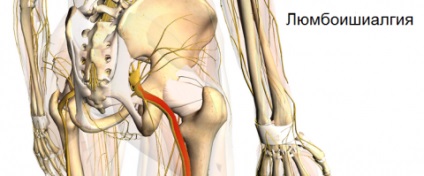 Cauzele, simptomele, diagnosticul și tratamentul cauzate de lumbo-sciatică