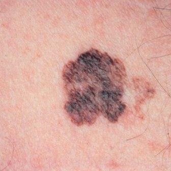 Melanoma metasztázisok különböző szervekben, típusokban és tünetekben