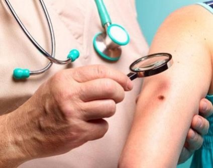 Melanoma metasztázisok különböző szervekben, típusokban és tünetekben