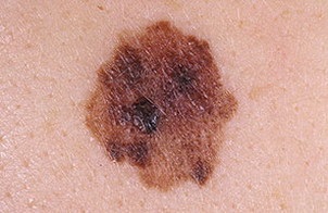 Metastazele melanomului în diverse organe, tipuri și simptome