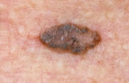 Melanoma metasztázisok különböző szervekben, típusokban és tünetekben