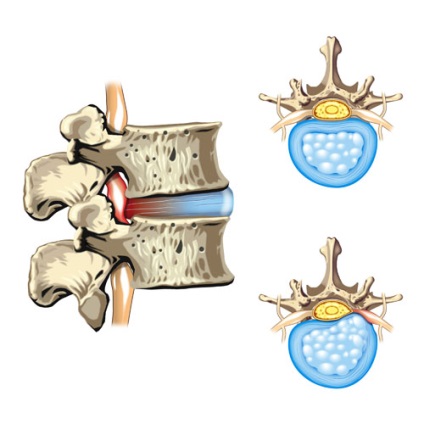 Hernia intervertebrală a coloanei vertebrale lombare