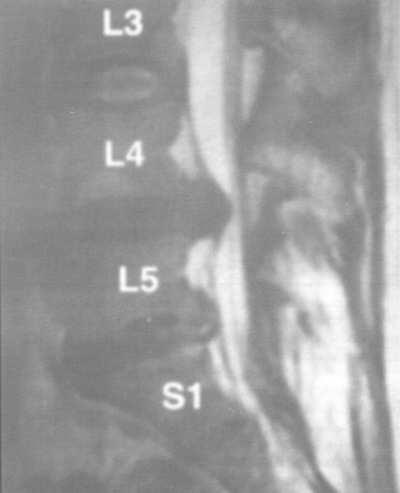 Neurologie și neuropatologie - lomboschialgie - enciclopedie medicală