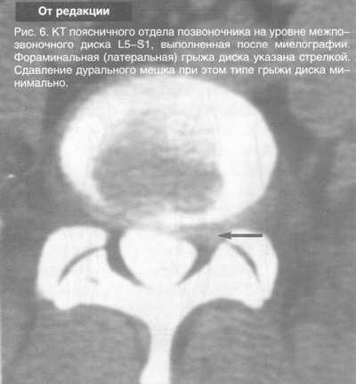 Neurologie și neuropatologie - lomboschialgie - enciclopedie medicală