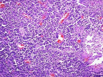 Neuroblastomul se manifestă și cum se vindecă o boală periculoasă