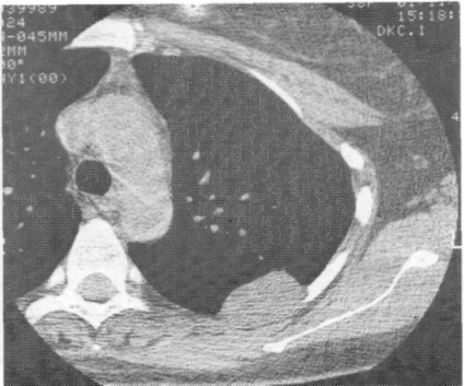 Tumorile pleurei, tomografie computerizată