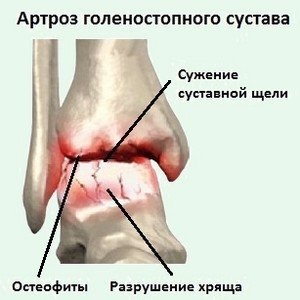 Só lerakódás az ízületek a megnyilvánulás, az okok, hogyan kell kezelni