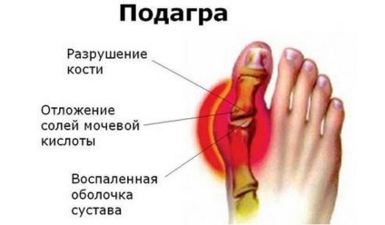 Só lerakódás az ízületek a megnyilvánulás, az okok, hogyan kell kezelni