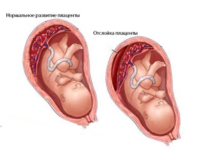 Abrupția placentară la începutul sarcinii