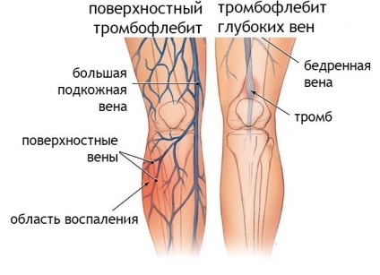 Táplálkozás a lábfejnél fellépő hasnyálmirigyeknél, thrombophlebitis esetén
