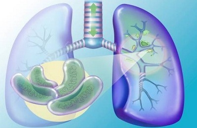 Ultima etapă a tuberculozei câți trăiesc, consecințele și complicațiile