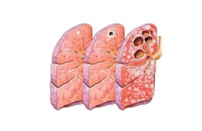 A tuberkulózis utolsó szakaszában hányan élnek, a következményeket és szövődményeket