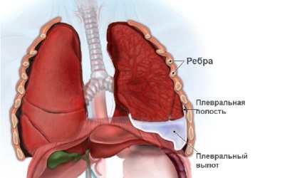 A tuberkulózis utolsó szakaszában hányan élnek, a következményeket és szövődményeket