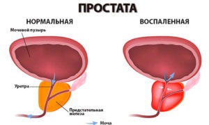 Consecințele adenomului de prostată - simptome și metode de tratament