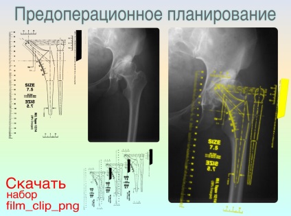 Planificarea preoperatorie a operațiunilor