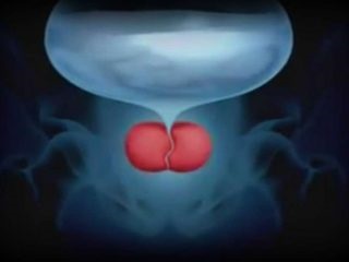 Profilaxia adenomului de prostată la bărbați