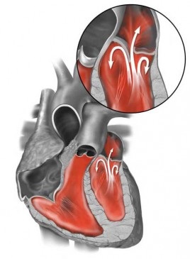 Prolapsul valvei mitrale, cauze, simptome, tratament