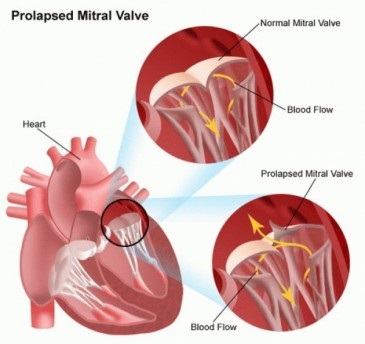 Prolapsul valvei mitrale, cauze, simptome, tratament