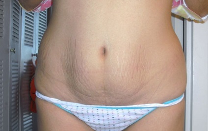 Stretch marks a gyomorfotókról és a jogorvoslatról